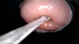 cervix sounding endoscopy quickie strangecares