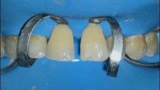 [1.38 GB] - Diastema Closure - Medical Vore Dentist - Colette Fetish