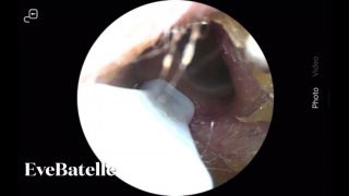 [408.09 MB] - Extreme Up-Close Ear Wax Extraction And Inspection - Eve Batelle